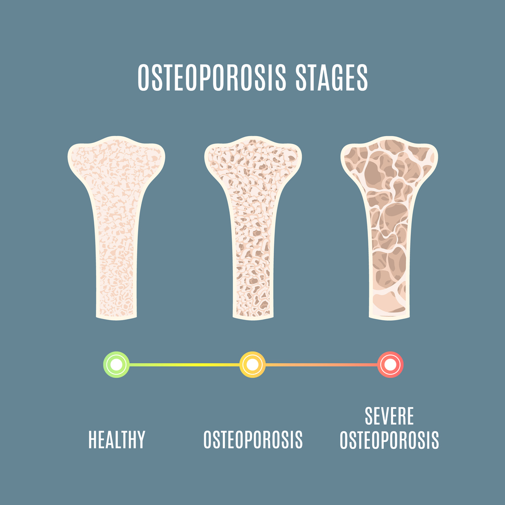 مای دارو - پوکی استخوان یا استئوپروز (Osteoporosis)