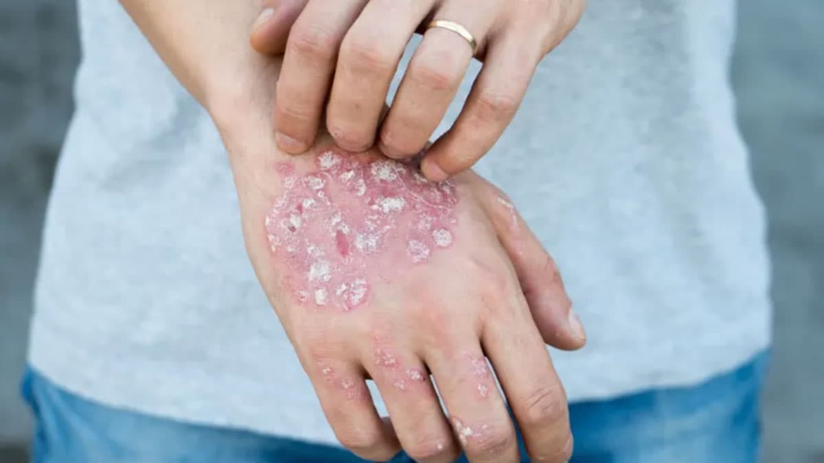 پسوریازیس پلاکی