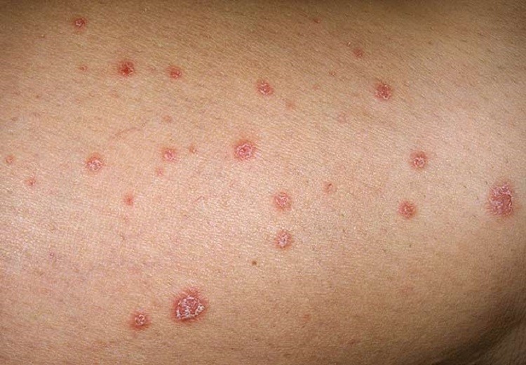 پسوریازیس قطره‌ای