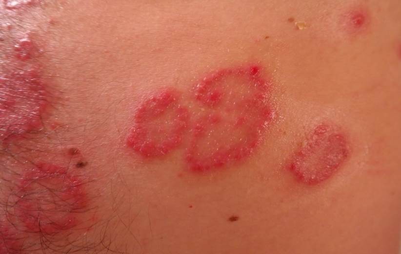 پسوریازیس چرکی